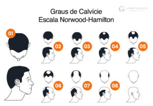 Graus Calvicie Transplante Capilar Bh Andre Giannini