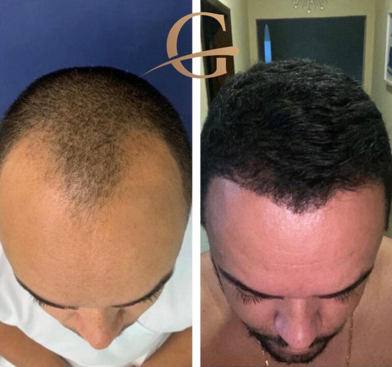 Transplante Capilar FUE em Belo Horizonte