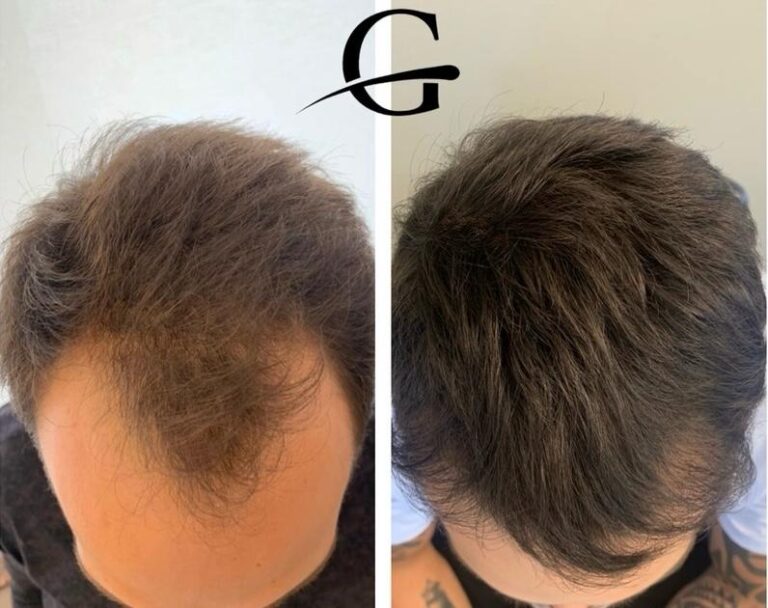 Transplante Capilar FUE em Belo Horizonte