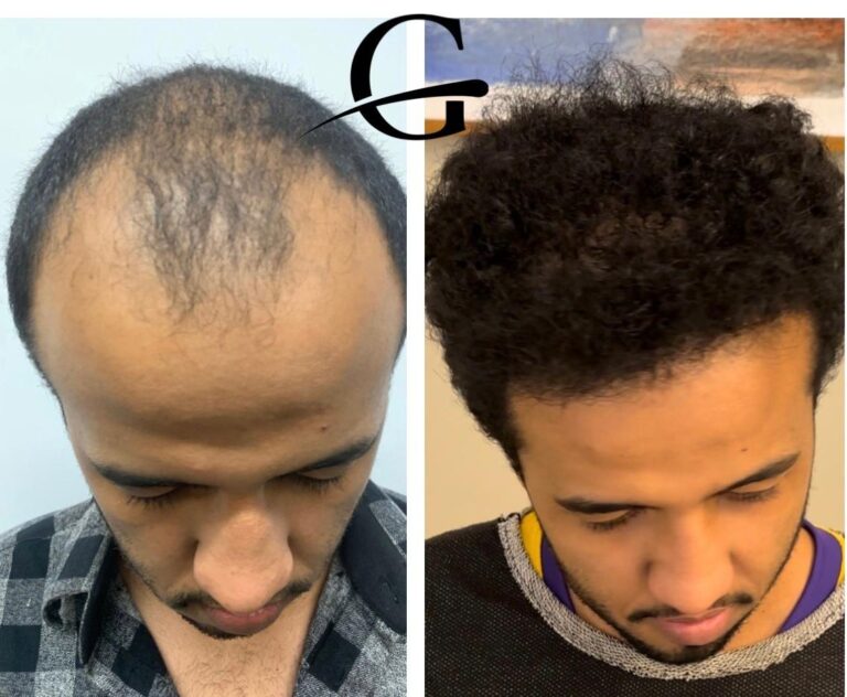 Transplante Capilar FUE em Belo Horizonte