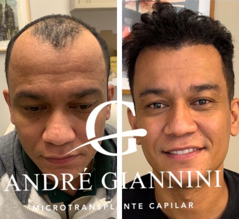 Transplante Capilar FUE em Belo Horizonte