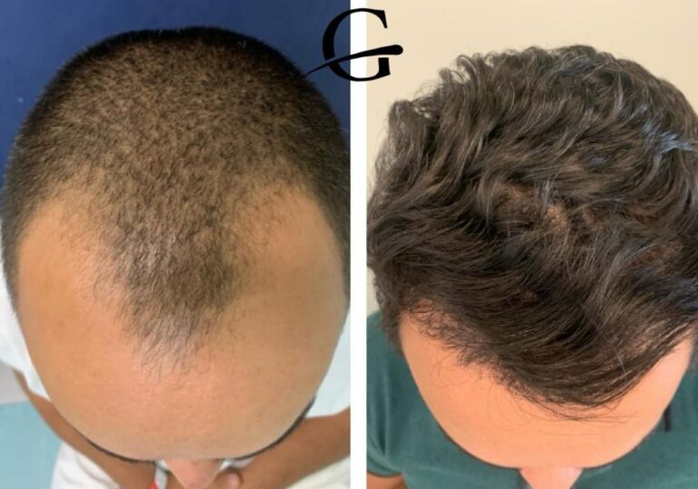 Transplante Capilar FUE em Belo Horizonte