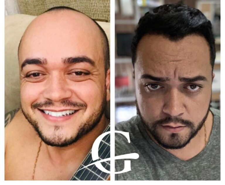 Transplante Capilar FUE em Belo Horizonte