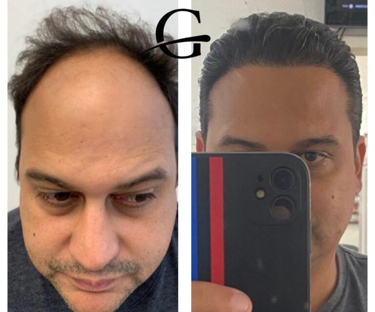 Transplante Capilar FUE em Belo Horizonte