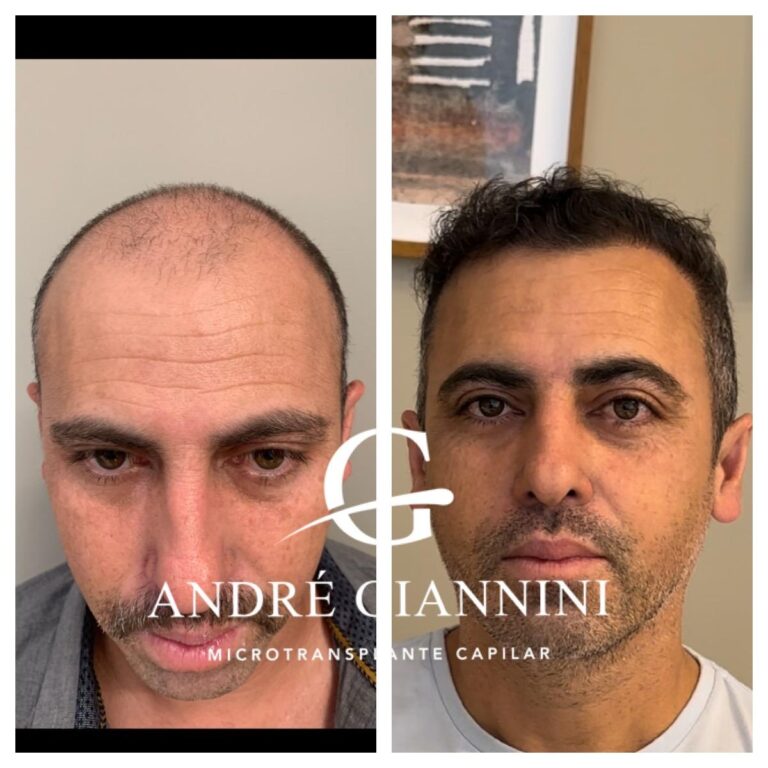Transplante Capilar FUE em Belo Horizonte