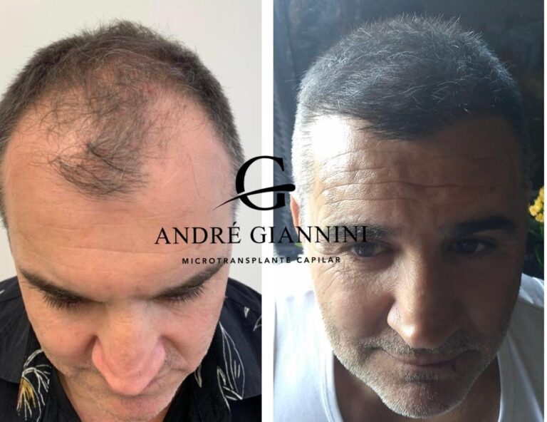 Transplante Capilar FUE em Belo Horizonte