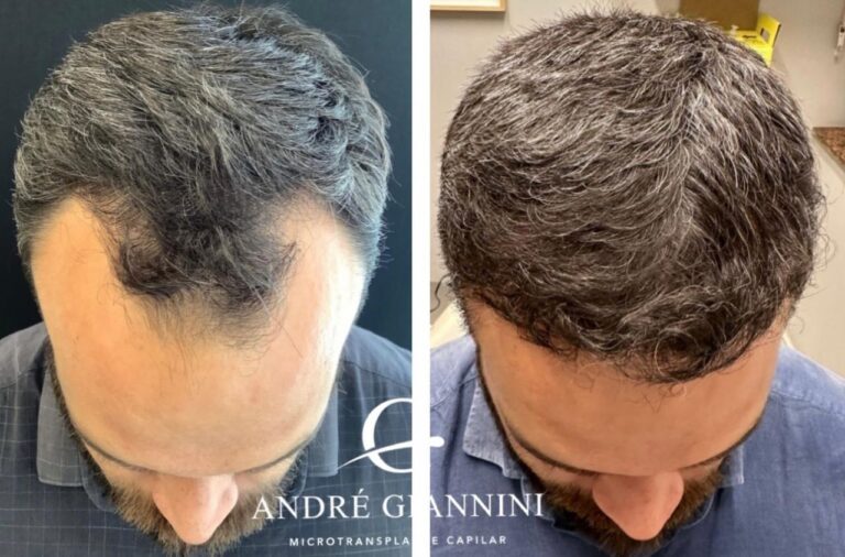 Transplante Capilar FUE em Belo Horizonte