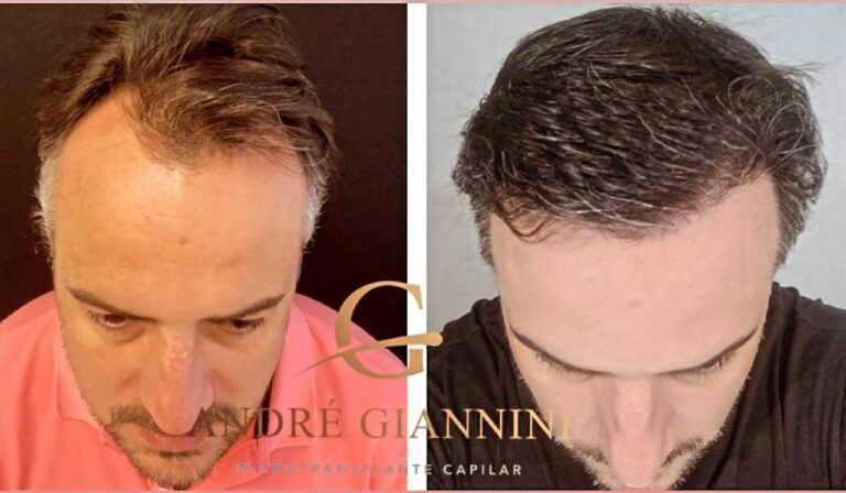 Transplante Capilar FUE em Belo Horizonte