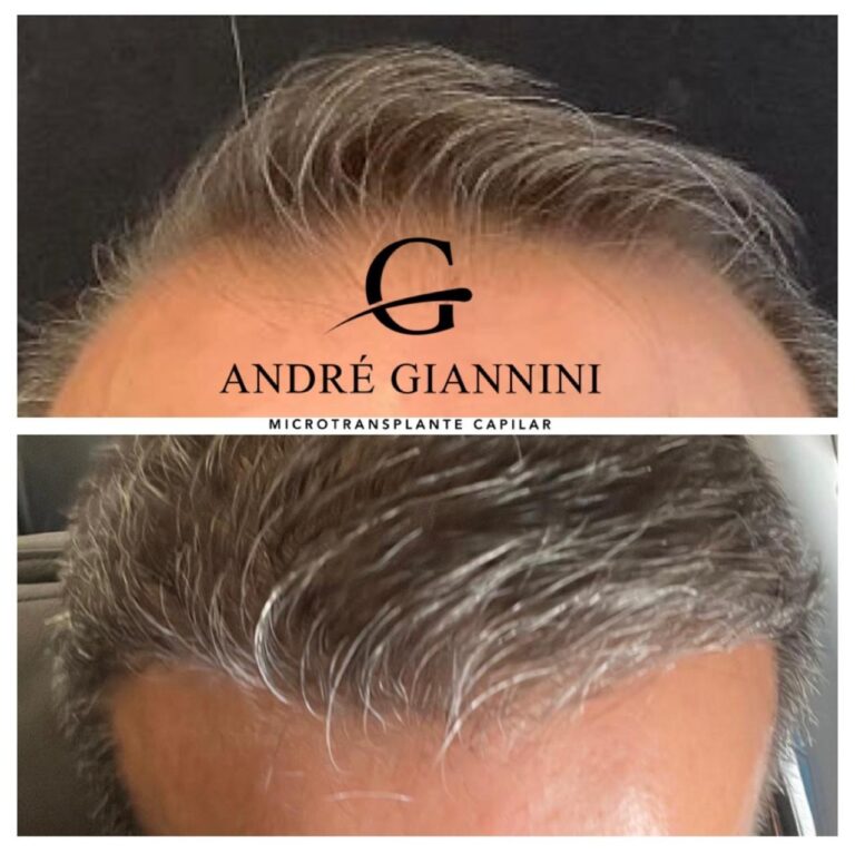 Transplante Capilar FUE em Belo Horizonte
