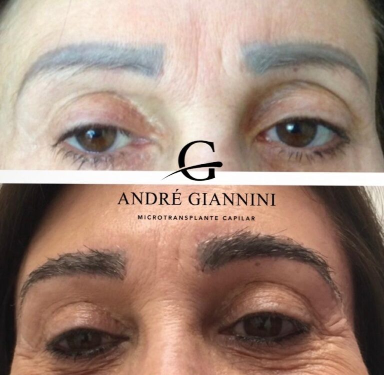 Transplante Capilar FUE em Belo Horizonte