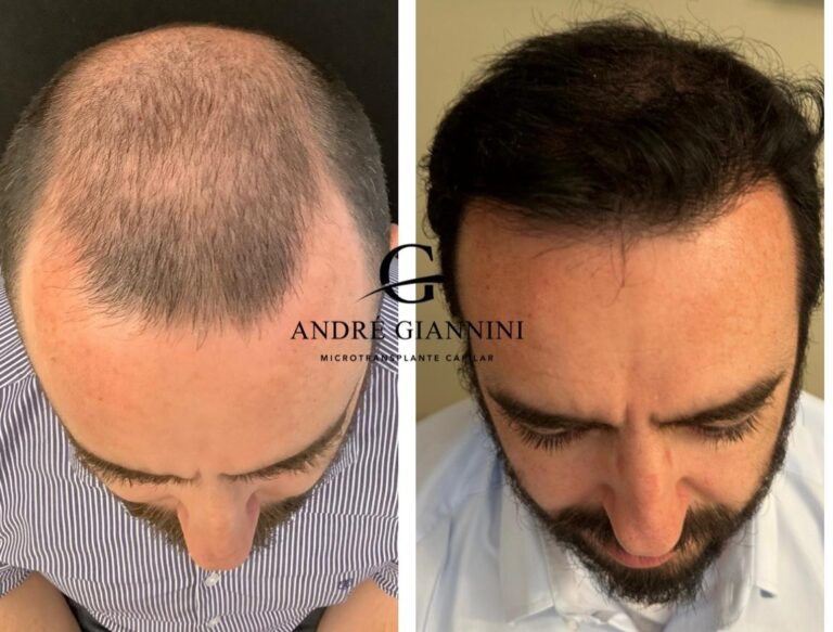Transplante Capilar FUE em Belo Horizonte