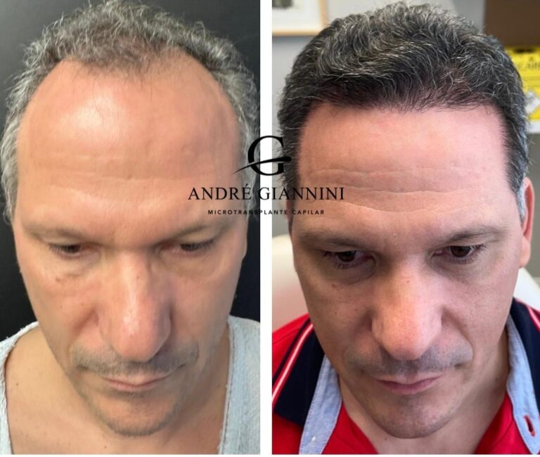 Transplante Capilar FUE em Belo Horizonte