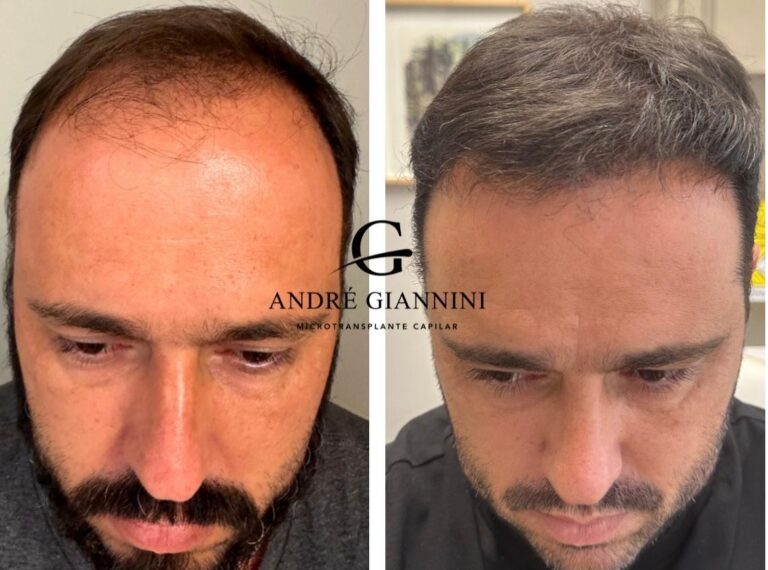 Transplante Capilar FUE em Belo Horizonte