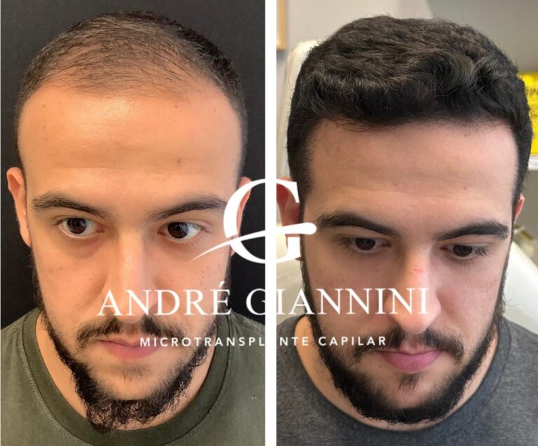 Transplante Capilar FUE em Belo Horizonte