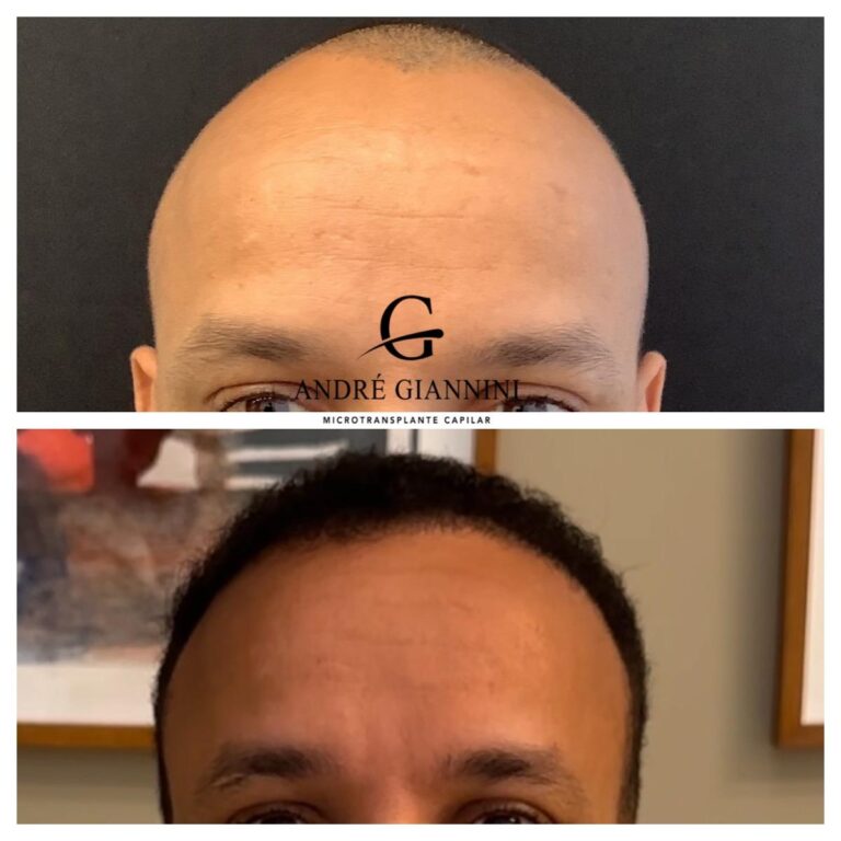 Transplante Capilar FUE em Belo Horizonte