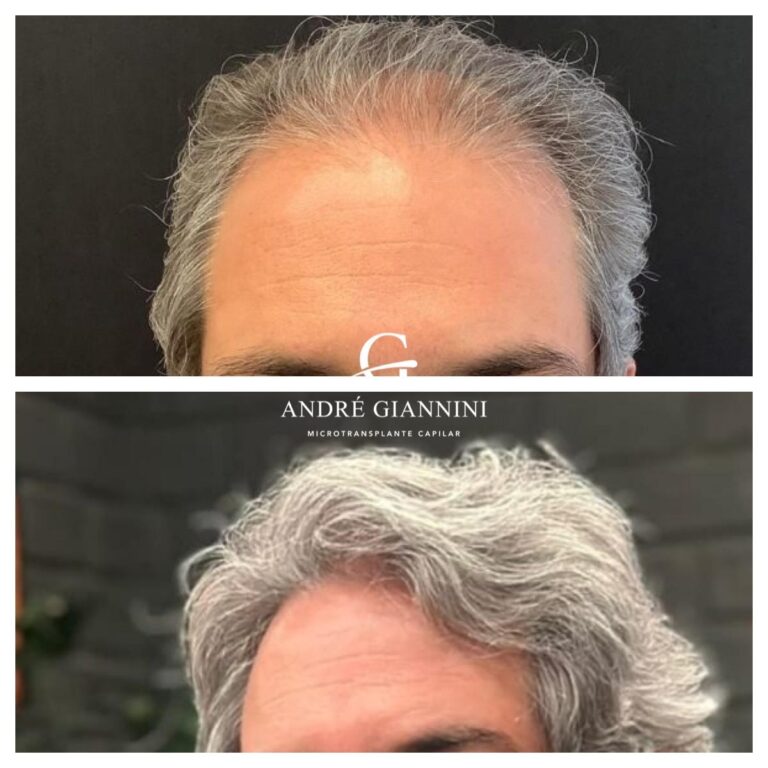 Transplante Capilar FUE em Belo Horizonte