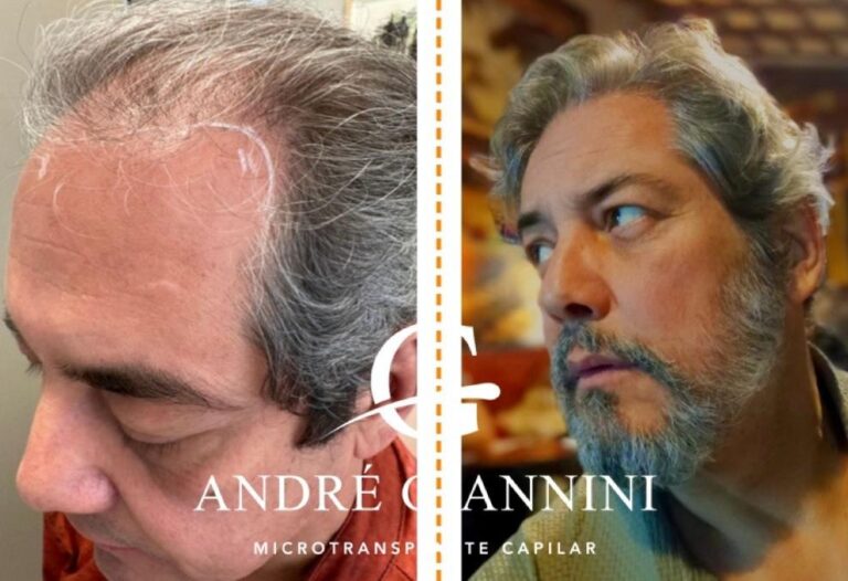 Transplante Capilar FUE em Belo Horizonte