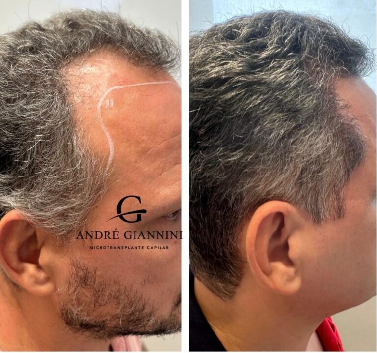 Transplante Capilar FUE em Belo Horizonte