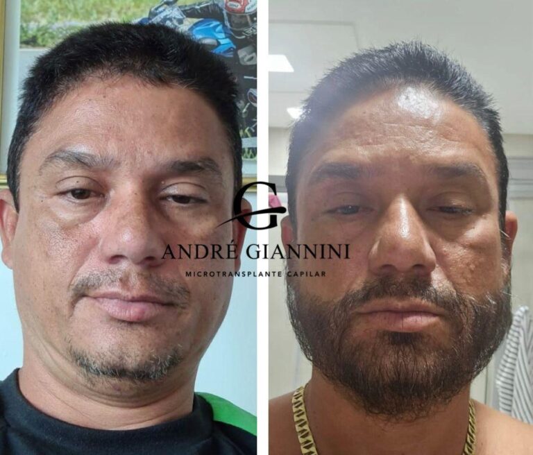 Transplante Capilar FUE em Belo Horizonte