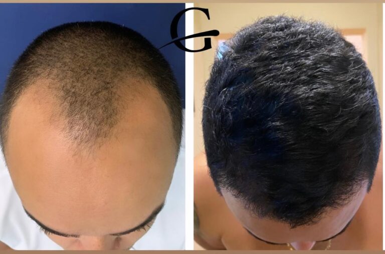 Transplante Capilar FUE em Belo Horizonte
