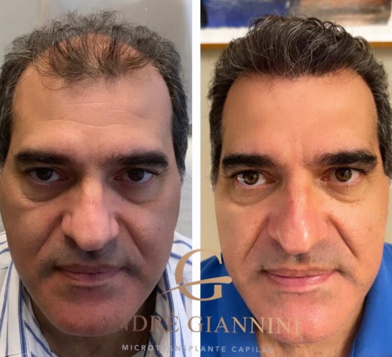 Transplante Capilar FUE em Belo Horizonte