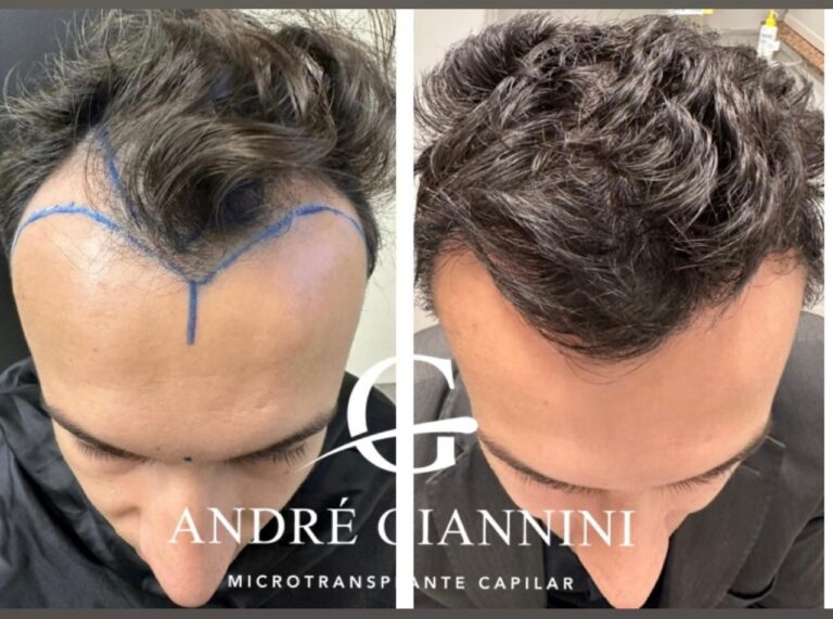 Transplante Capilar FUE em Belo Horizonte