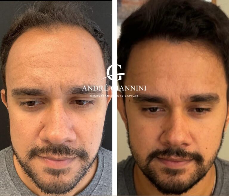 Transplante Capilar FUE em Belo Horizonte